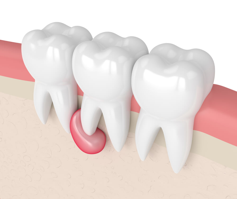 Zubne ciste: Kako nastaju i kako se leče