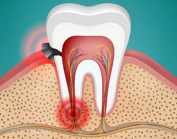 Gangrena zuba – Simptomi, uzroci, opasnosti i lečenje